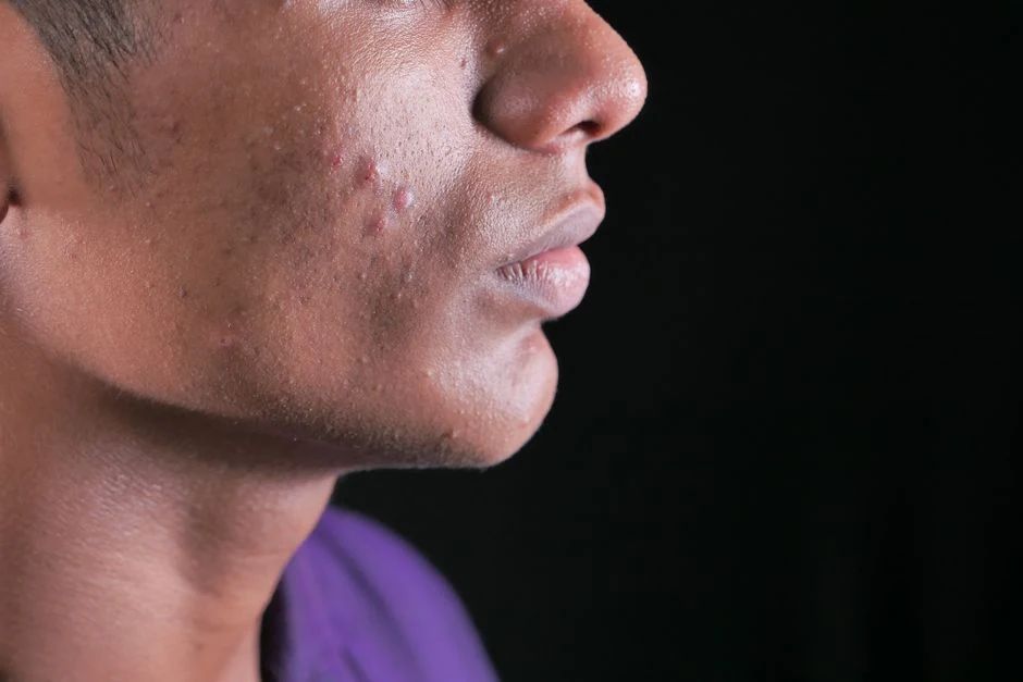 Close-up showing inflammatory acne on the cheek and jawline.