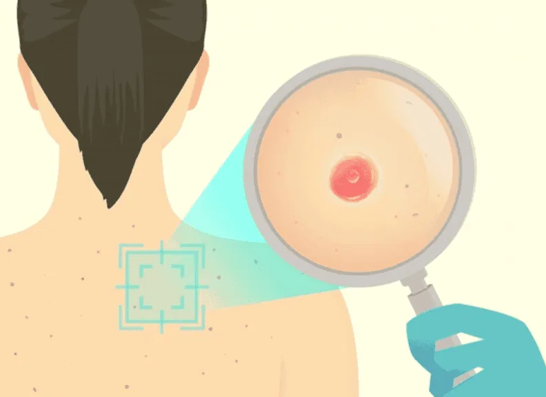 Basal Cell Carcinoma: The Most Common – and Most Treatable – Skin Cancer