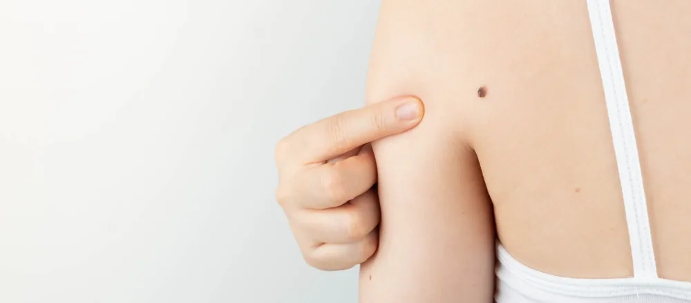 A person points to a mole on their upper arm, demonstrating a key step in a skin self exam how to. Regular skin checks are important.