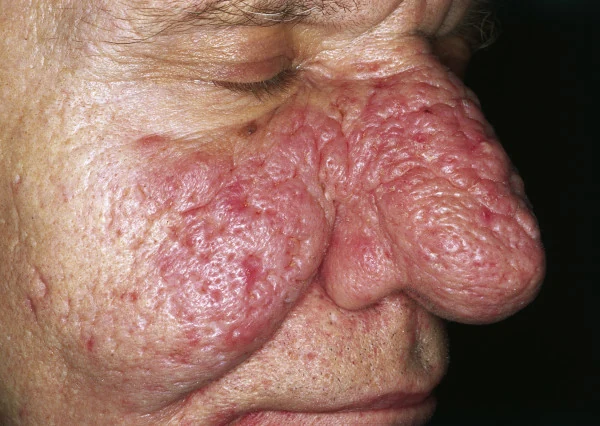 Close clinical view of nasal skin thickening and enlarged pores associated with rhinophyma