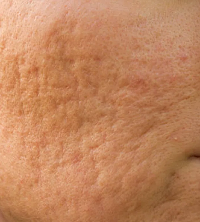 Acne Scars | PS Dermatology and Surgery