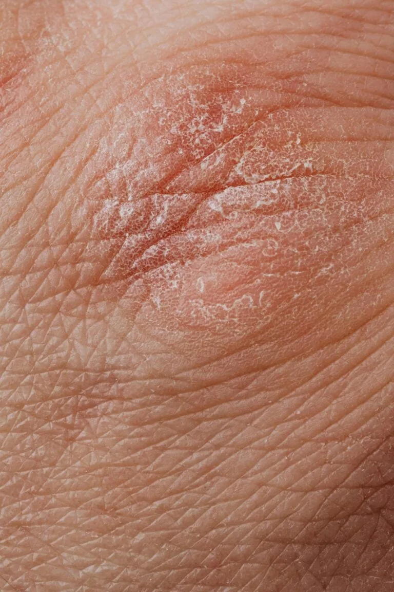 Atopic Dermatitis - Adults in Bridgewater, NJ | PS Dermatology and Surgery
