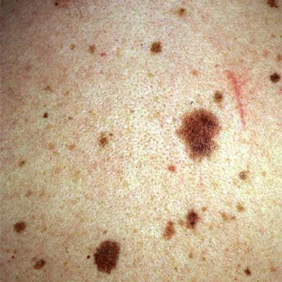 Atypical Nevus in Bridgewater, NJ | PS Dermatology and Surgery
