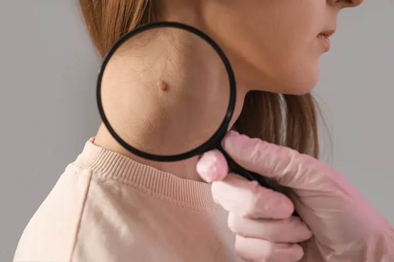 Basal Cell Carcinoma in Bridgewater, NJ | PS Dermatology and Surgery
