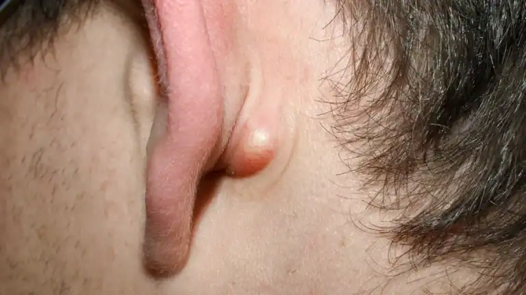 Cysts in Bridgewater, NJ | PS Dermatology and Surgery