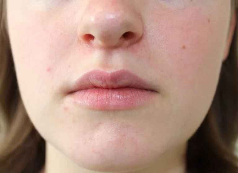 Perioral Dermatitis in Bridgewater, NJ | PS Dermatology and Surgery