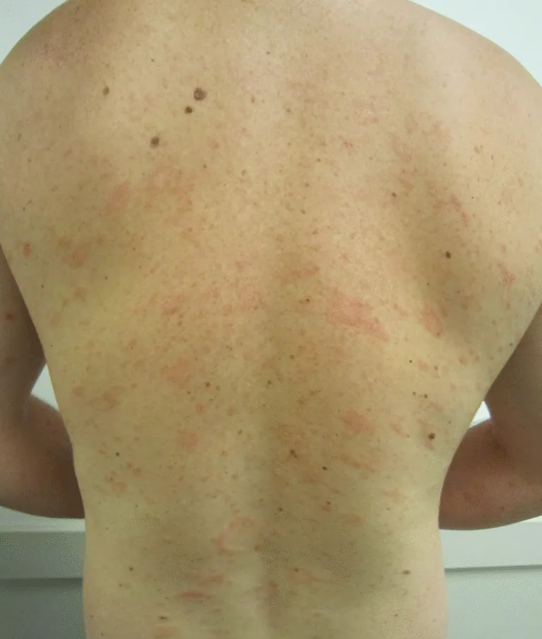 Pityriasis Rosea in Bridgewater, NJ | PS Dermatology and Surgery