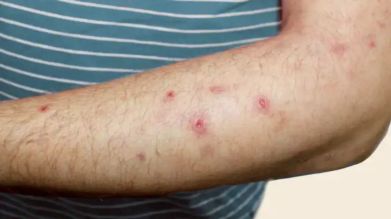 Prurigo Nodularis and LSC in Bridgewater, NJ | PS Dermatology and Surgery