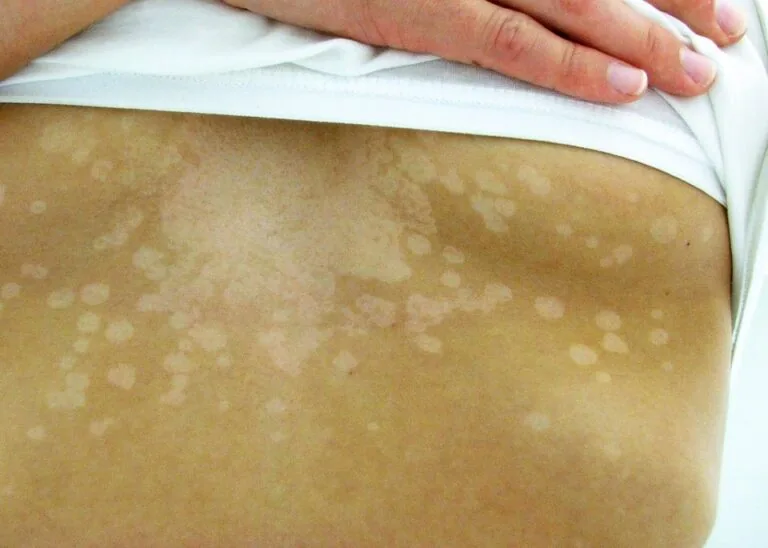 Psoriasis Treatment in Bridgewater NJ | PS Dermatology