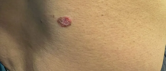 Squamous Cell Carcinoma in Bridgewater, NJ | PS Dermatology and Surgery