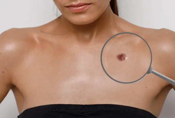 Warts in Bridgewater, NJ | PS Dermatology and Surgery