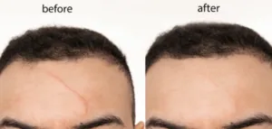 Fraxel Dual laser treatment infographic